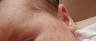 Вероятные причины покраснения и шелушения кожи при появлении красных пятен у ребенка на лице У малыша красное лицо